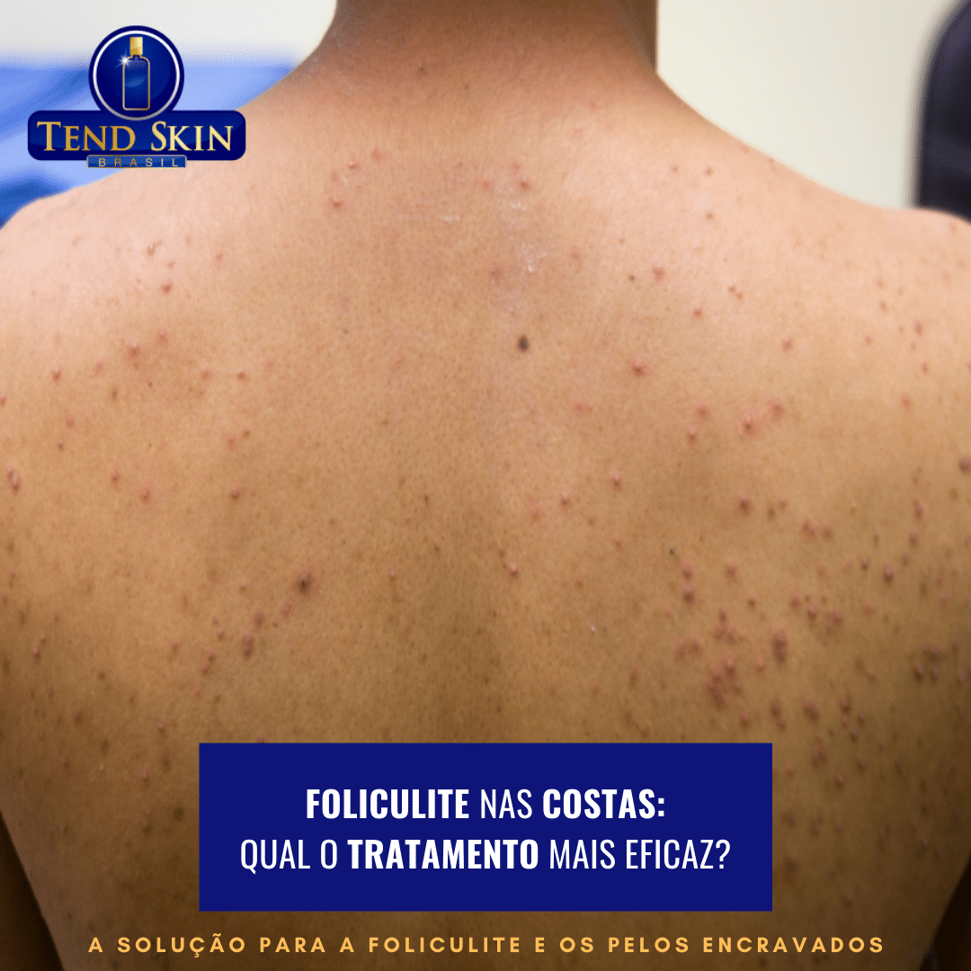 foliculite nas costas