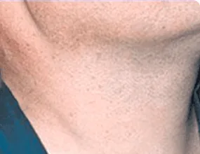 Barba depois do tratamento